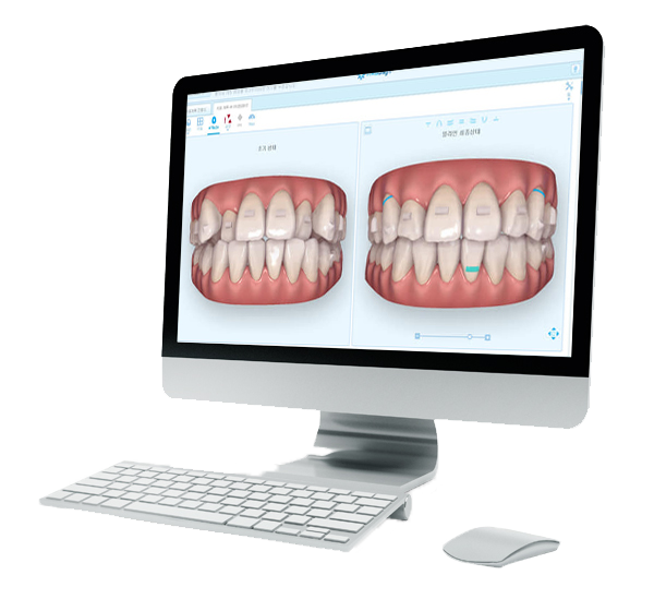 ClinCheck 프로그램
